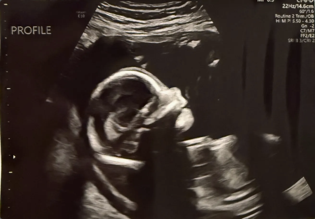 Ultrasound April 8, 2026