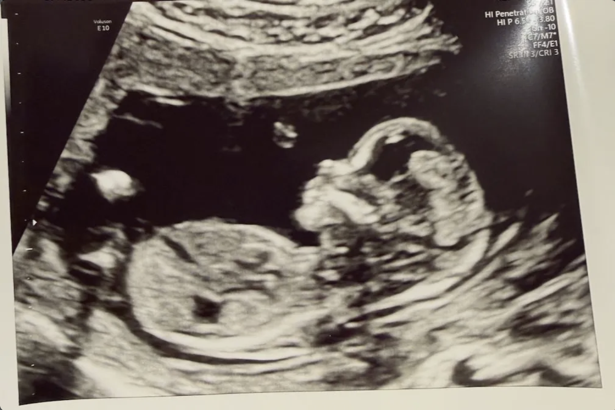 Ultrasound February 19, 2026